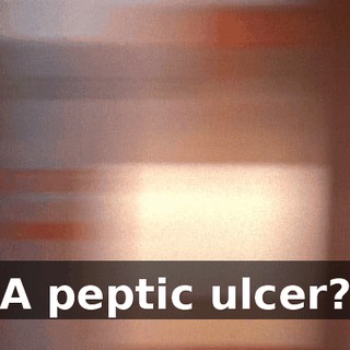 A peptic ulcer?